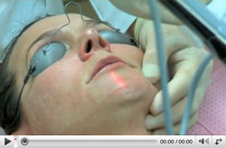 microlaserpeel-youtube