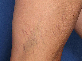 spider-veins-example